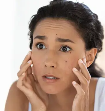 How To Remove Moles From Face Naturally?